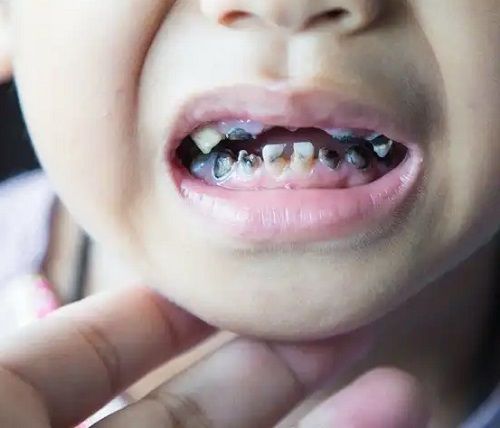 Gigi Susu Berlubang Apakah Harus Dicabut